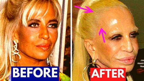 Botched Celebrity Plastic Surgery Before And Afters Youtube