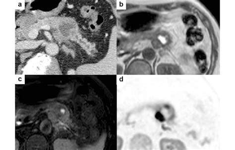Computed Tomography Image A Mass In The Tail Of The Pancreas With
