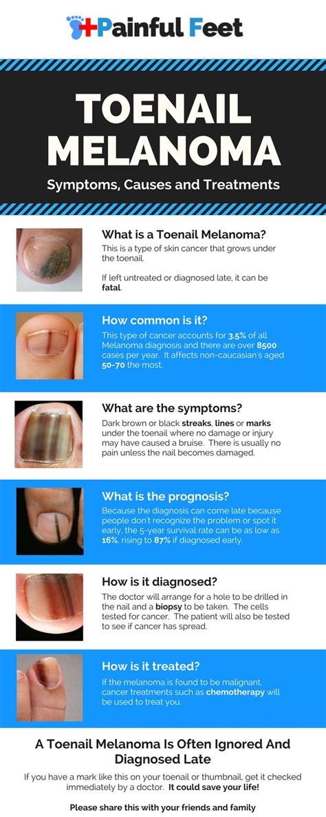 Infographic About Toenail Melanoma A Skin Cancer That Grows Under