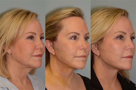 Before And After Facelift And Neck Lift Photos