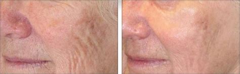 Crepey Skin Southern Cosmetic Laser Charleston Botox Massage