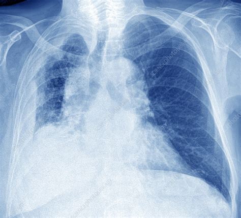 Mesothelioma Lung Cancer Frontal Chest X Ray Stock Image C0486148