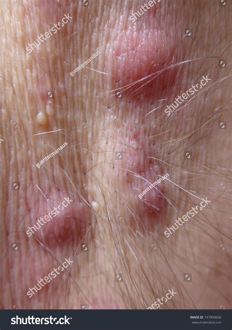 Hidradenitis Suppurativa Over Royalty Free Licensable Stock Photos