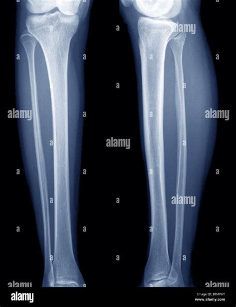 Healthy Legs X Ray Hi Res Stock Photography And Images Alamy