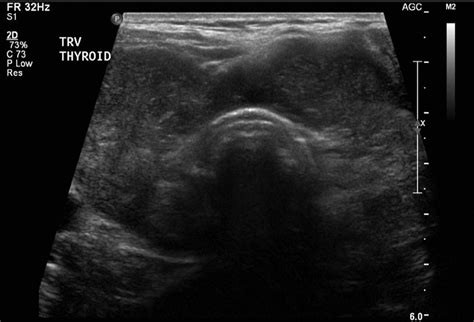 Ultrasound Of The Thyroid Gland Shows A Diffusely Enlarged And