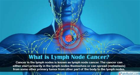 Lymph Node Cancercausessignssymptomstreatmentrecovery Period