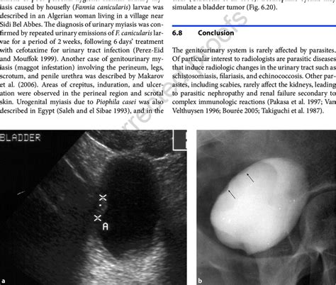 20 Eosinophilic Cystitis A Ultrasound Examination Of The Bladder