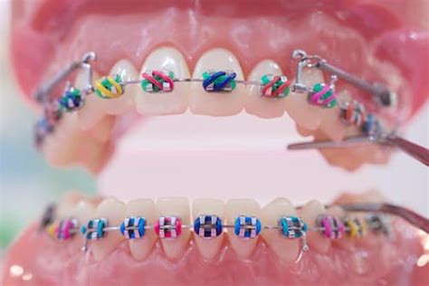 Brackets De Colores Tu Sonrisa De Colores Dental Tacna