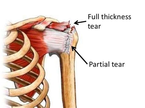 Full Thickness Rotator Cuff Tears Value Of Clinical Tests
