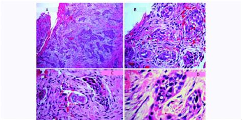 Histopathology Of Microcystic Adnexal Carcinoma Skin Biopsy Of The