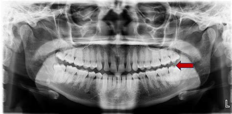 A Panoramic Radiograph Portraying Bilateral Partially Impacted