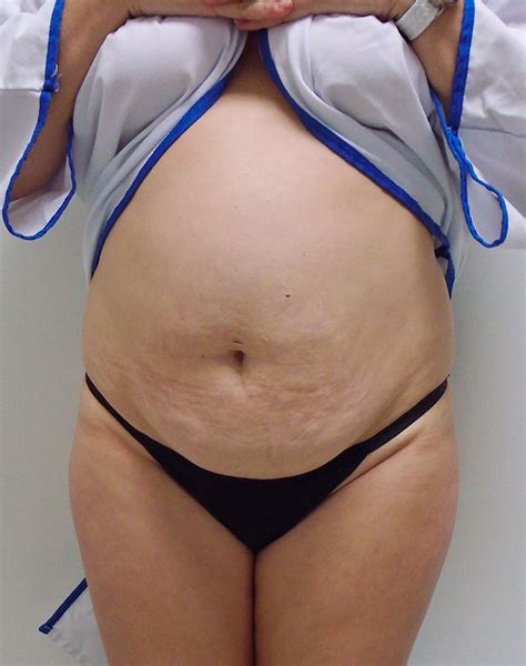 Abdominoplasty Before And After Rashid Plastic Surgery
