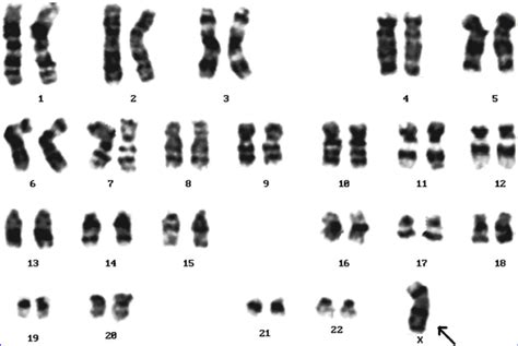 A Female Karyotype Showing A Loss Of X Chromosome Turners Syndrome Download Scientific