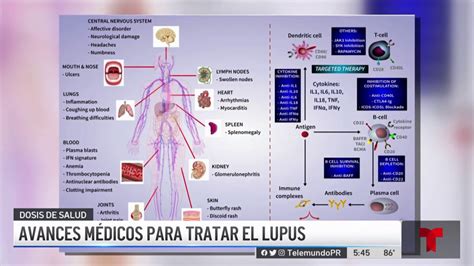 Dosis De Salud Avances Médicos Para Tratar El Lupus Telemundo Puerto