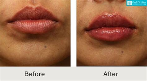 Is Permanent Lip Filler Really A Thing Carolina Facial Plastics