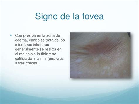 Diapositivas De Sindrome Edematoso Dr Espinosa