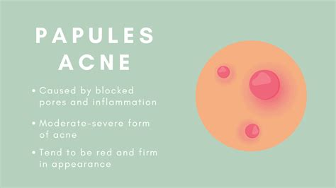 The 8 Types Of Acne And How To Treat Them Goodglow
