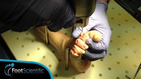 Lab Demo Fuseright Hammer Toe Surgical Correction Youtube