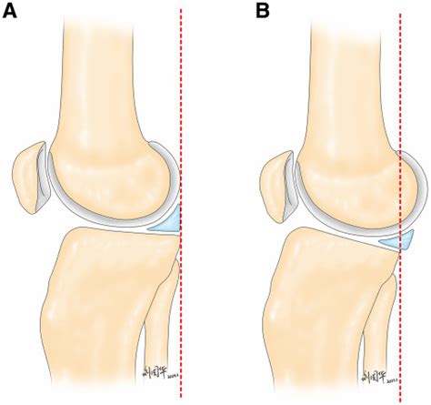 Steep Posterior Tibial Slope And Excessive Anterior Tibial Translation