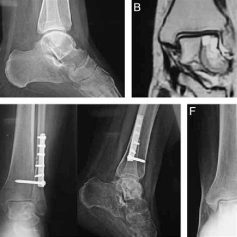 A Ap And Lateral X Rays Of The Ankle Showing Lytic Lesion Of The Talus