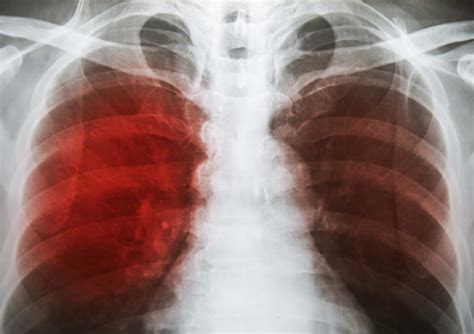 Tuberculosis (tb) is a bacterial disease that spreads through droplets in the air and mainly affects the lungs. El cannabis como tratamiento para la tuberculosis - Sensi ...