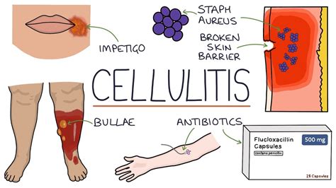 Erysipelas Vs Cellulitis Vs Impetigo