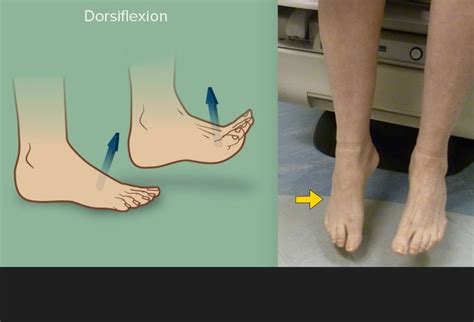 Tibial Peroneal Nerve Foot Drop
