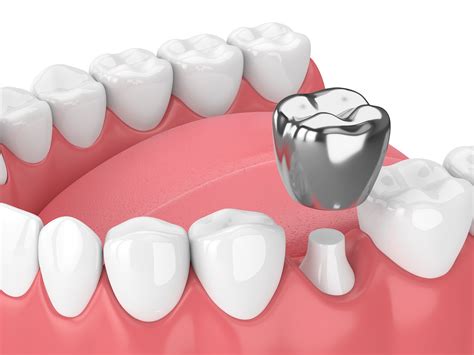 The Pros And Cons Of A Silver Tooth Cap Prv Dental