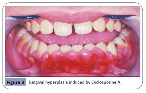 Review On Differential Diagnosis Of Drug Induced Gingival Hyperplasia