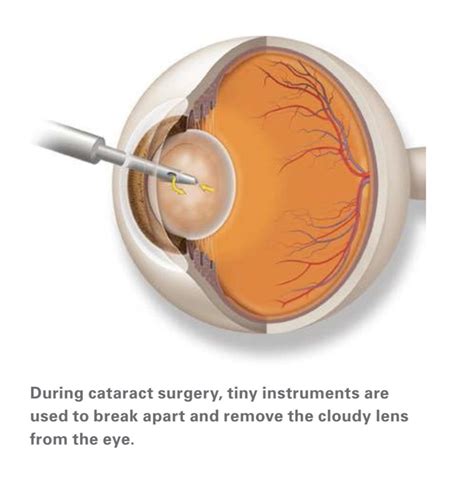 No Gap Cataract Surgery Strathfield Eye Surgery