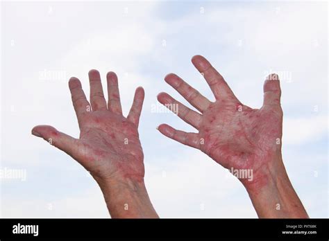 Endogenous Eczema Hi Res Stock Photography And Images Alamy