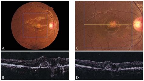 Fundus Photograph A Of A Patient With Choroidal Neovascularization