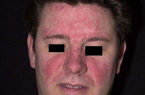 Seborrhoeic Dermatitis Face