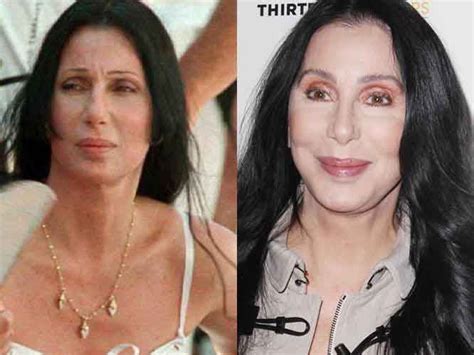 Cher Plastic Surgery 3
