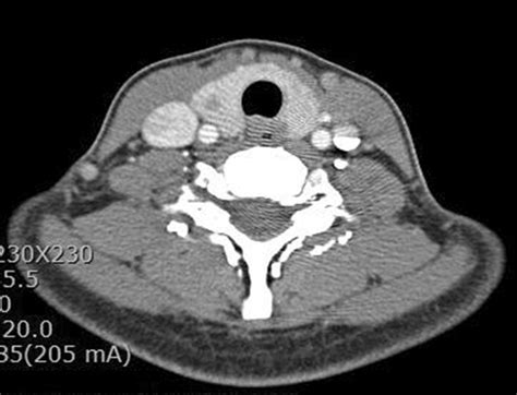Preoperative Radiological Imaging Of Papillary Thyroid Carcinoma A