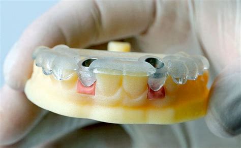 ImplantologÍa La Impresión 3d Clave En Los Nuevos Implantes Dentales