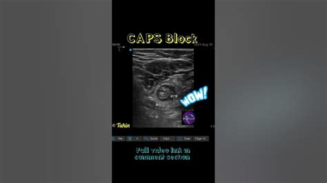 Caps Block Popliteal Sciatic Nerve Block Supine Lateral Approach