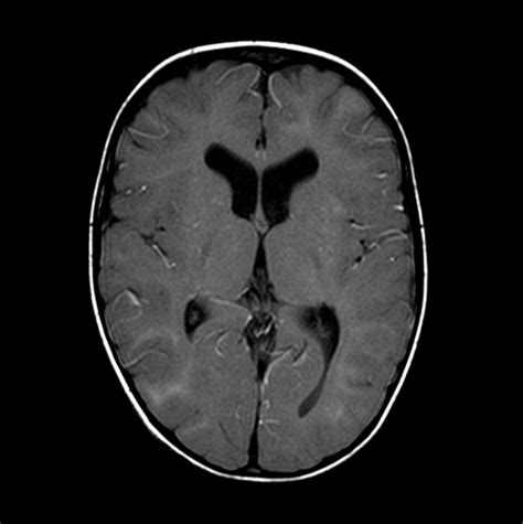 Suprasellar Arachnoid Cyst And Tuberous Sclerosis Image