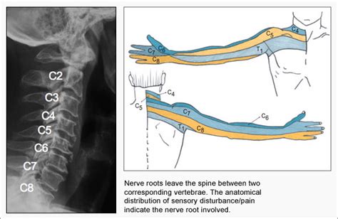 C7 C8 Pinched Nerve
