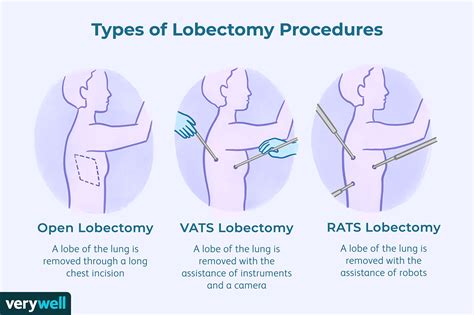 Lobectomie Chirurgie Pulmonaire Types Complications Et Pronostic