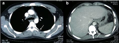 A Baseline Contrast Enhanced Ct Scan Cect Of The Chest Showing