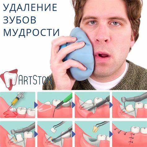 Диета при удаление зубов мудрости ‼Принимая решение о том, надо ли удалять зубы мудрости, нужно тщательно ‼Принимая решение о том, надо ли удалять зубы мудрости, нужно тщательно Диета при удаление зубов мудрости