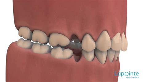 What does a retainer do? Will My Teeth Shift After Wisdom Teeth Removal - TeethWalls