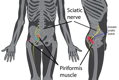 Sciatica and Low Back Pain: Are They the Same Thing? - Specialized