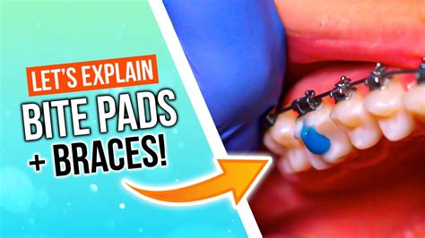 What Are Bite Pads For Braces Youtube