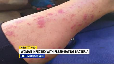 Woman Infected With Flesh Eating Bacteria After Swim At Fort Myers Beach Newsbreak