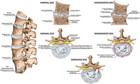 Intervertebral Disc Anatomy Function Degeneration Herniation