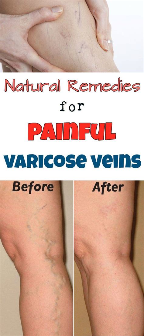Natural Remedies For Painful Varicose Veins Beauty