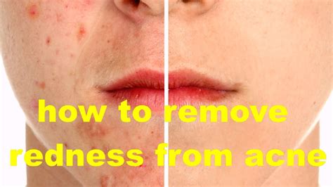 How To Remove Redness From Acne Scars Overnight Get Rid Of Acne With