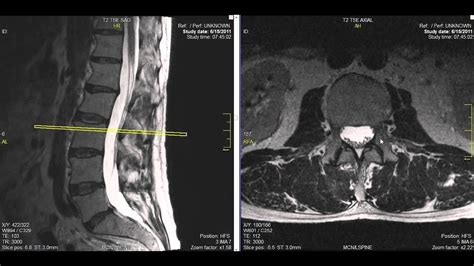 Lower Back Mri Lumbar Spine